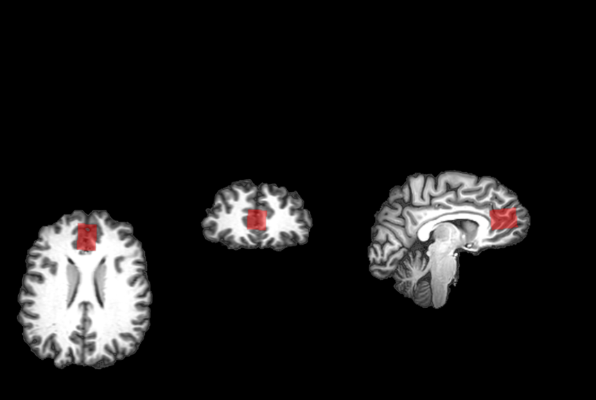 Region des präfrontalen Kortex, in der die Forschungsgruppe Veränderungen in der Balance bestimmter Botenstoffe während einer Psychotherapie untersucht hat.